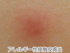 アレルギー性接触皮膚炎の画像