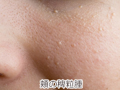 頬の稗粒腫（はいりゅうしゅ）の写真