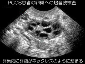 PCOS患者の超音波検査のネックレスサインの画像