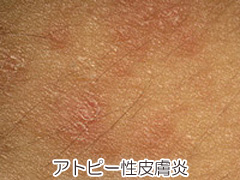 アトピー性皮膚炎の画像