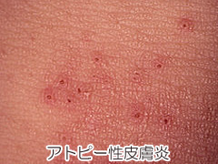 アトピー性皮膚炎の写真