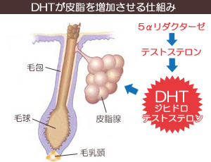 ジヒドロテストステロン（DHT）が皮脂を増加させる仕組み
