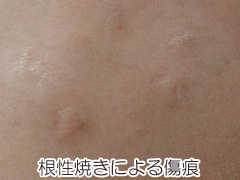 根性焼きによる傷痕の画像