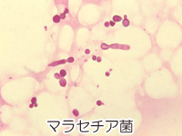 マラセチア菌の画像