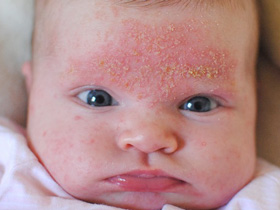 乳児の脂漏性湿疹の画像