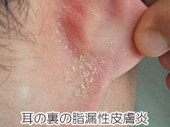 耳の裏の脂漏性皮膚炎の画像