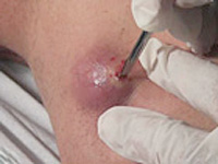 化膿した粉瘤（アテローマ）の画像