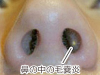 鼻の中の毛嚢炎（毛包炎）の画像