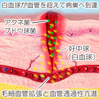 毛細血管拡張と血管透過性亢進の画像