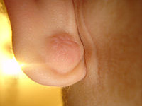 耳たぶの粉瘤
