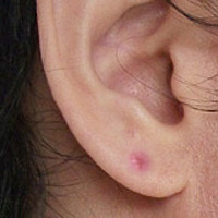 耳ニキビの原因と治し方 ニキビとは違う粉瘤の可能性も